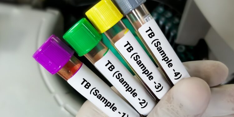 टीबी के 61 प्रतिशत मरीज सहमत कि उन्हें चाहिए पौष्टिक आहार