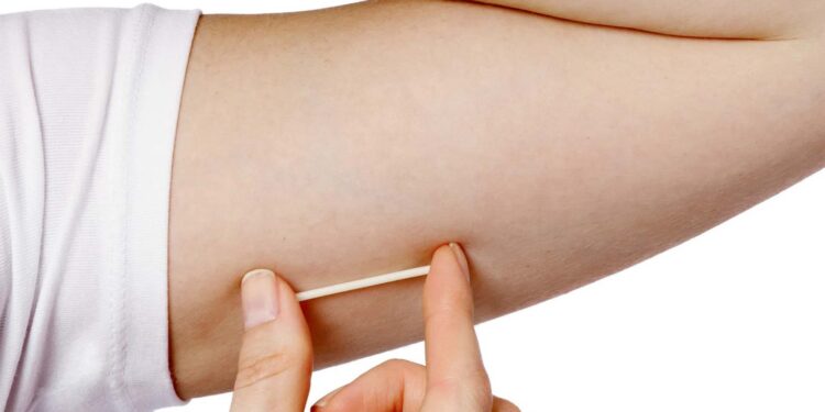 फारबिसगंज अनुमंडल अस्पताल में शुरू हुआ सबडर्मल गर्भनिरोधक इंप्लांट की सुविधा